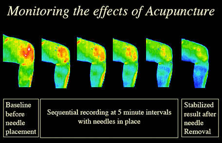  - Thermography-of-Acupuncture-Tx-of-Knee1